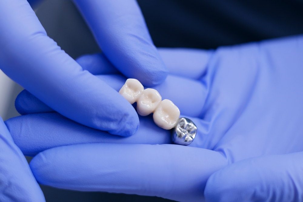 Dental Bridge Replace Missing Teeth