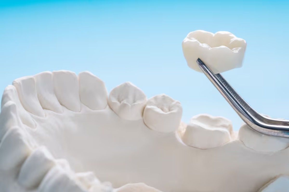 Dental Crowns: What They Are and When You Need One