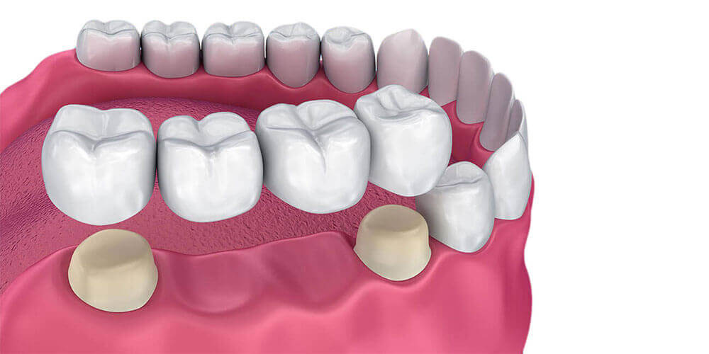 Dental Bridges Edmonton