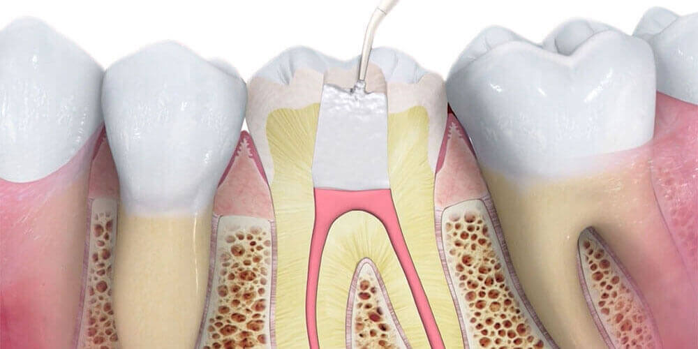Root Canal Treatment Edmonton